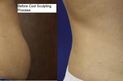 58-year-old American Undergoes Fat Reduction Procedure Post-Cancer Battle