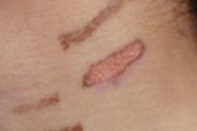 First-Degree Laser Burns Can Take Around a Year or Two to Heal