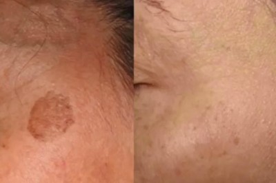 Innovative Treatment Helps Individuals in the UAE Combat Skin Irregularities and Unwanted Tattoos