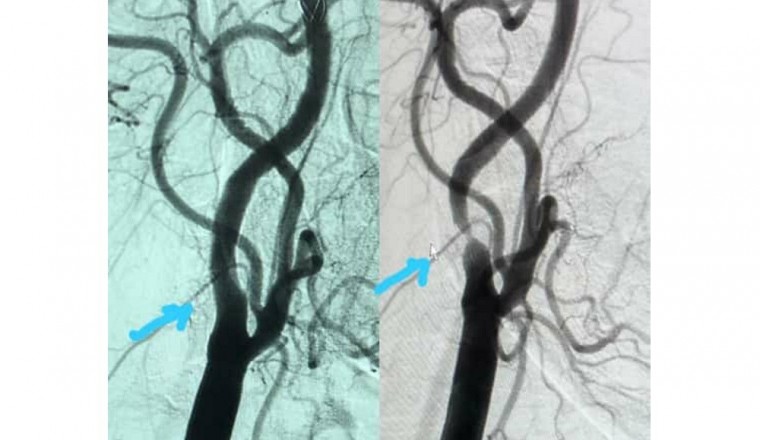 Interventional Cardiologist successfully performs a rare Carotid Stent