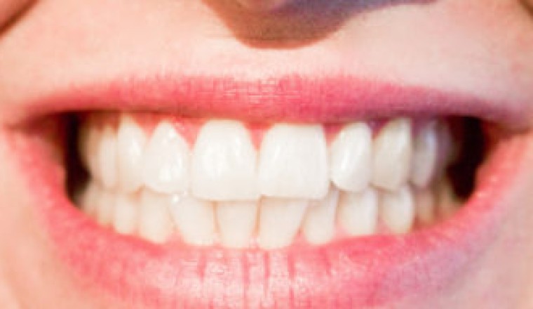 Dental Sealants In Abu Dhabi | Emirates Royal Center