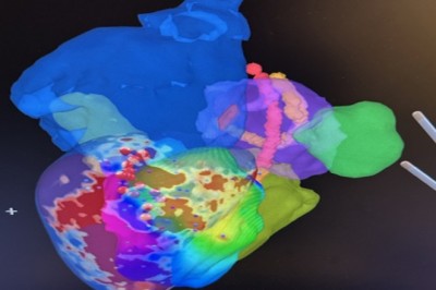 أول عملية استئصال عضلة القلب البطينية الإقفارية البشرية بنجاح في iCMR